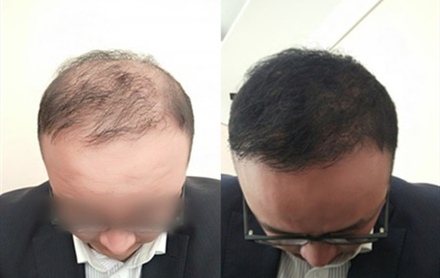 【最新】秃顶5年,经过3个月的努力,头发终于长出来了!不看后悔一辈子!